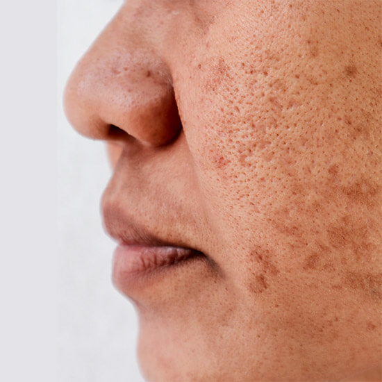Home Remedies to treat Dark Spots and Pigmentation