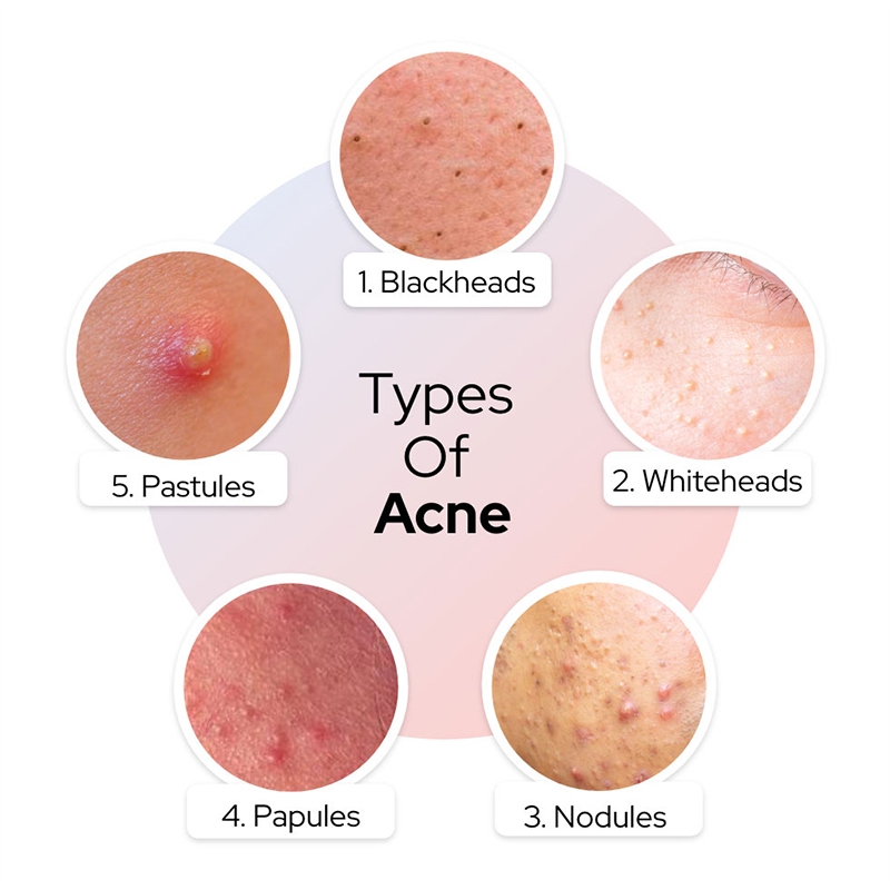 Types of Acne