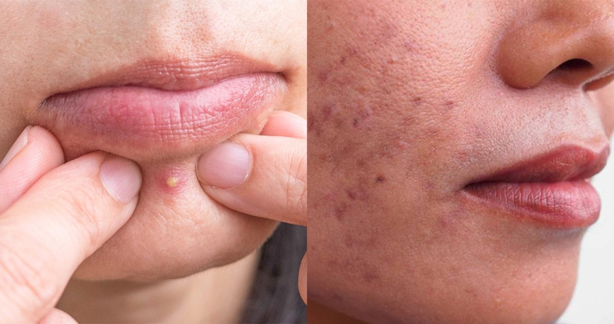 How to get rid of pimple and acne?