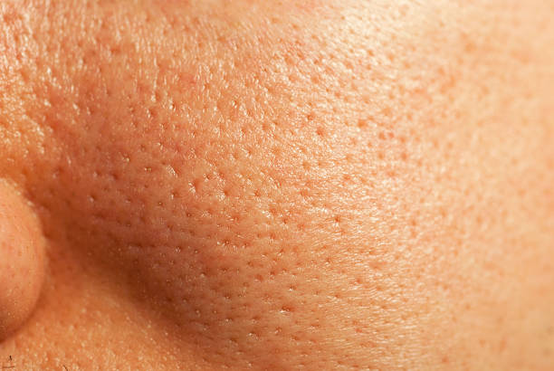 Enlarged Open Pores – what causes Enlarged Pores How to rectify it ? check out the Tips
