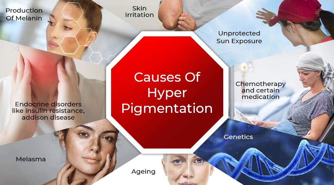 causes of hyper pigmentation