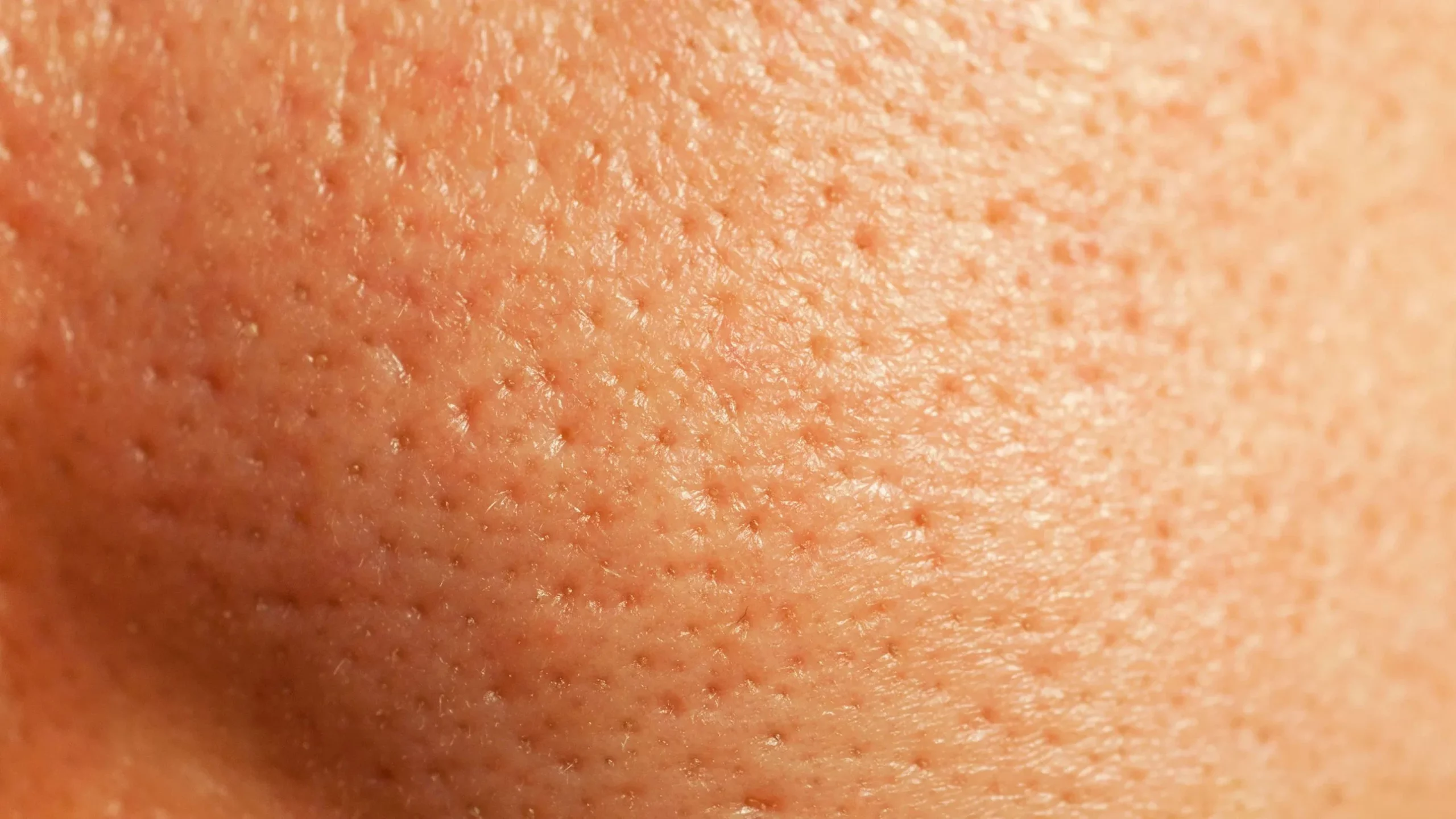 Get rid off open pores with these simple home remedies