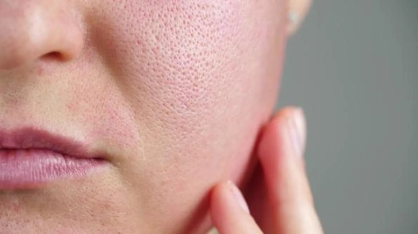 All you need to know about Open Pores